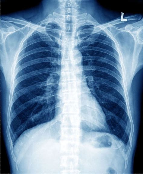 Dr Cătălin Costovici Riscul dezvoltării unui cancer pulmonar este mai mare la persoanele care