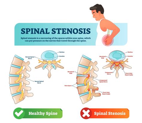 Spinal Stenosis Treatment In New Jersey Comprehensive Spine Care