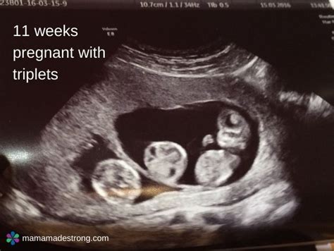 Triplets Pregnancy Ultrasound