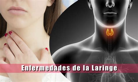 Enfermedades De La Laringe Laringitis Lesiones Cáncer Guía