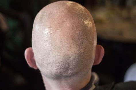 Scientists Discover New Breakthrough In Cancer Hair Loss Treatment