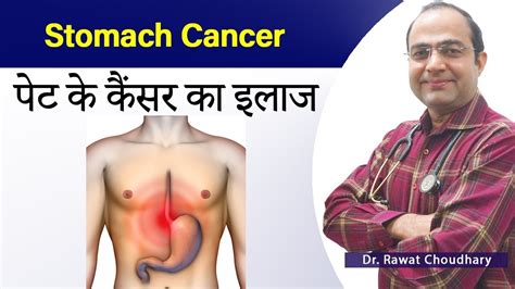 Stomach Cancer Treatment पट क कसर क इलज पट क कसर क लकषण