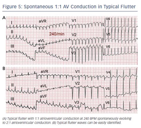 Figure 5 Spontaneous 1 1 AV Conduction In Typical Flutter Radcliffe