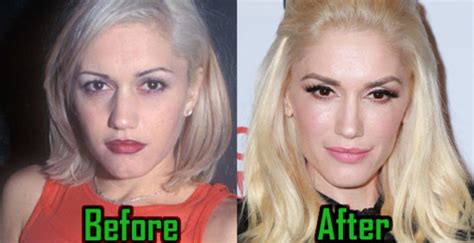 Gwen Stefani Plastic Surgery Facelift Nose Job Before After