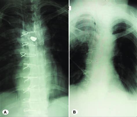 Pre A And Post Operative B X Ray Of The Same Patient Showing