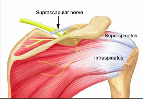 The other important anatomical structure involved in shoulder impingement is the subacromial subdeltoid (sasd) bursa. Supraspinatus Impingement and Shoulder Pain - Locomotion ...
