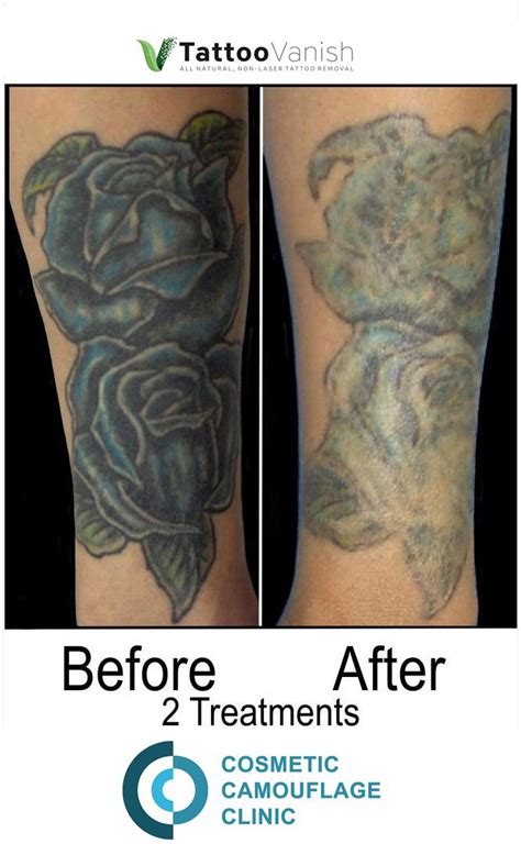 Discover Picosure Tattoo Removal Before And After Latest In Eteachers