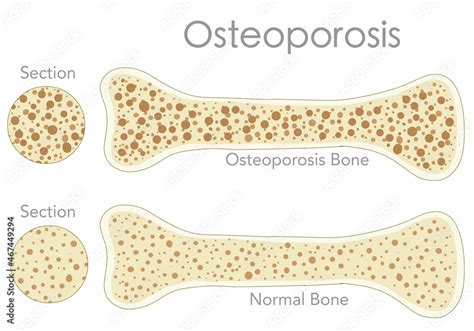 Porous Bone Osteoporosis Bone Cross Section Structure Pair Normal