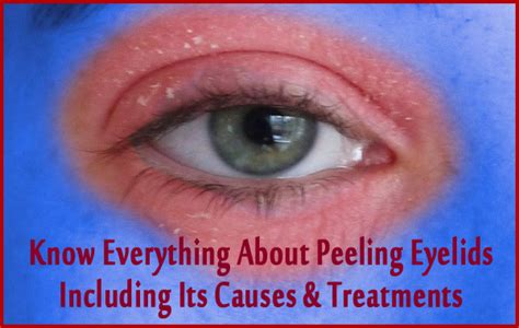 Know Everything About Peeling Eyelids Including Its Causes And Treatments