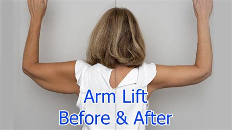 Arm Lift 14 Weeks Post Op Faqs Brachioplasty Surgery Journey Part 3