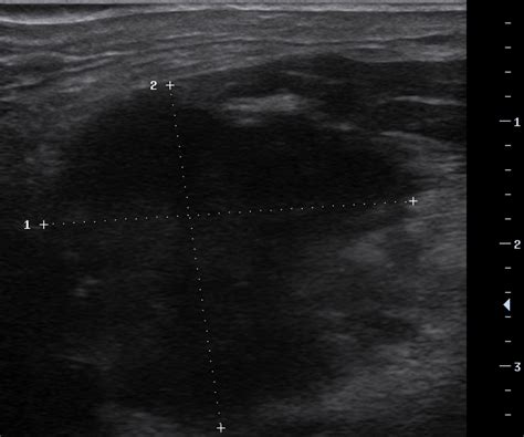 Right Neck Ultrasound Depicting A Hypoechoic Neck Mass With Poorly