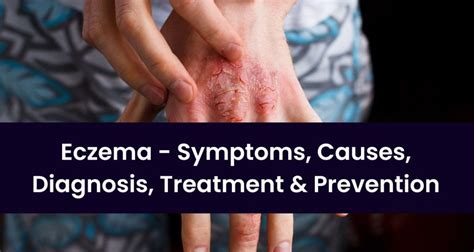 Eczema Symptoms Causes Diagnosis Treatment And Prevention