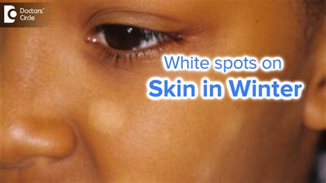 Ursachen Für Weiße Hautflecken Im Gesicht Eines Kindes Ezd