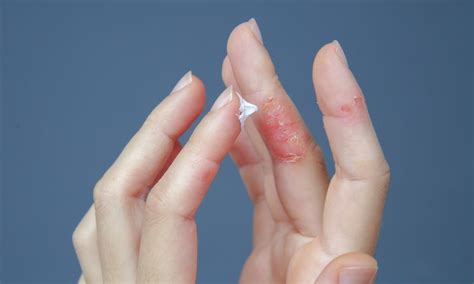 How To Treat Dyshidrotic Eczema On Your Hands February 8 2024