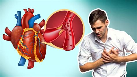 Myocardial Infarction All You Need To Know About This Heart Disease