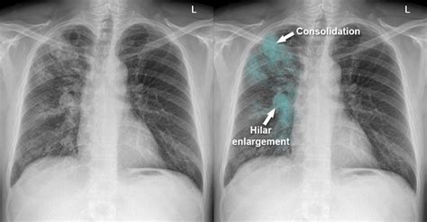 Tuberculosis Lung X Ray