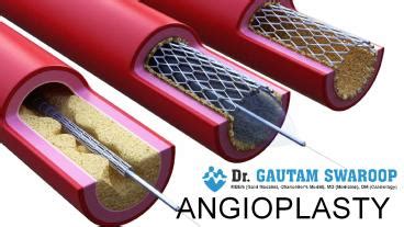 Ppt Angioplasty Doctor In Lucknow Dr Gautam Swaroop Cardiologist
