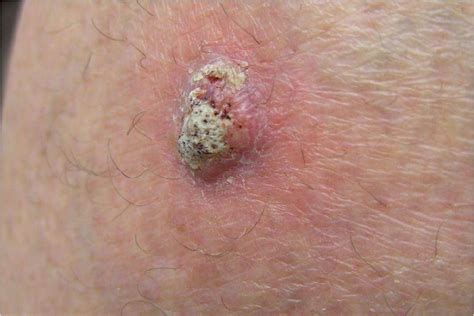 How Is Squamous Cell Skin Cancer Treated