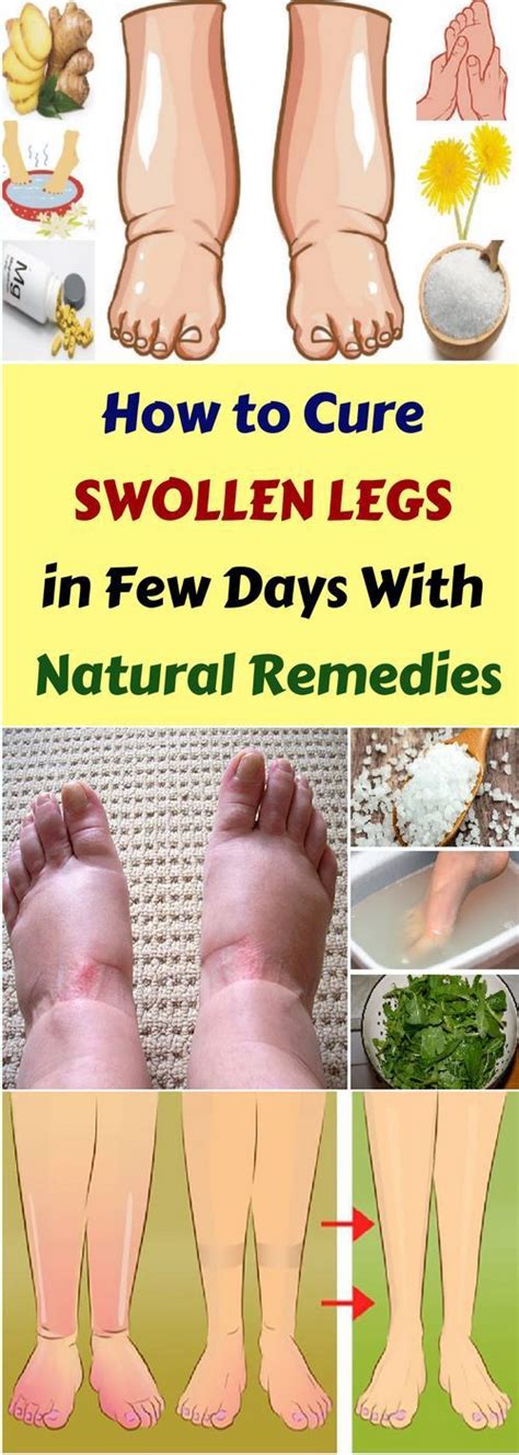 How To Cure Swollen Legs In Few Days And Natural Remedy All What You