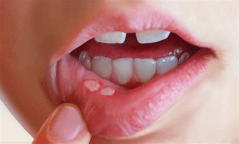 Canker Sores Triggers Treatments Heather Earles