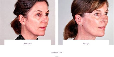 How To Get Rid Of Jowls Jowls Face Treatment London Buckinghamshire