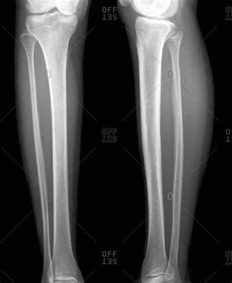 Leg Bones X Ray