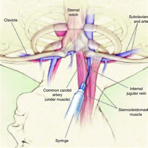 Placement Of A Central Venous Catheter In The Right Internal Jugular