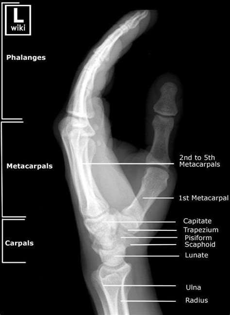 Hand Radiographic Anatomy Wikiradiography Diagnostic