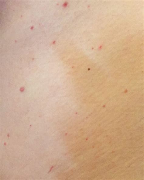 What Are Little Red Dots On Skin