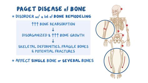 Paget Disease Of Bone Nursing Osmosis Video Library