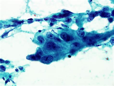 Qiaos Pathology Breast Cancer Cells Cytology A Photo On Flickriver