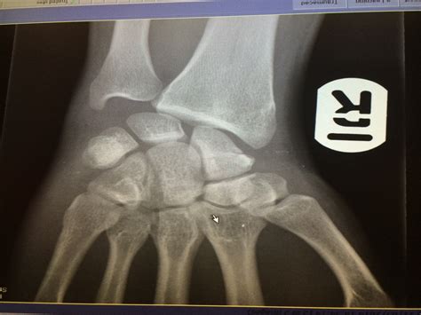 My Broken Wrist: The Full Story - 28 May 2014 ...