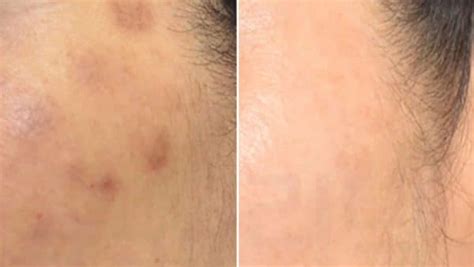 Pih Post Inflammatory Hyperpigmentation Questions Answered