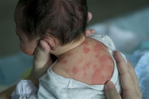 Newborn Rashes And Skin Conditions Urgent Care For Kids Near Me