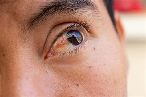 Exploring The Causes Of Subconjunctival Hemorrhage