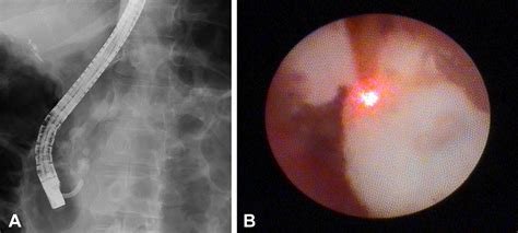 Ercp With Per Oral Pancreatoscopyguided Laser Lithotripsy For Calcific