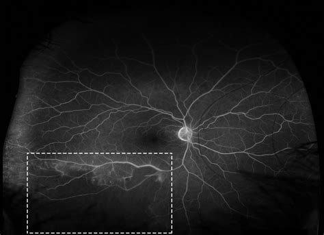 Retinal Vasculitis Eyewiki