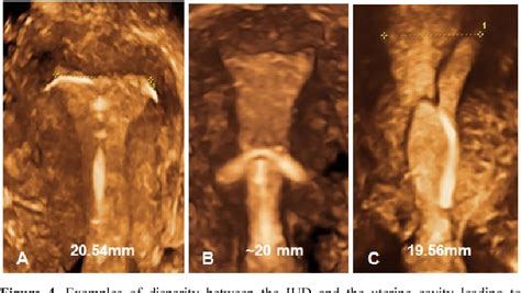 Figure From A Multicenter Study Assessing Uterine Cavity Width In Over Nulliparous Women