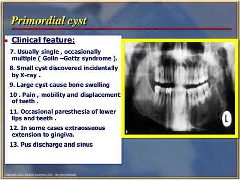 Jaw Bone Cyst