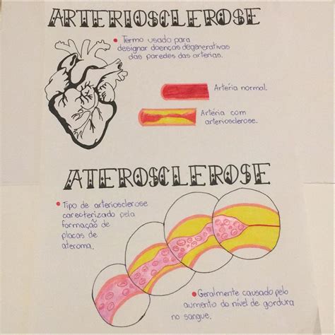 Diferença Entre Aterosclerose E Arteriosclerose