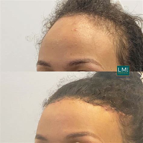 Hair Transplant And Hairline Lowering Lm Medical Nyc