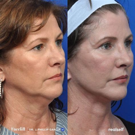 How Much Does A Facelift Cost And Is It Worth It Realself Facelift