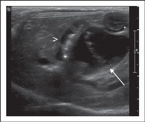 Figure 2 From Ultrasonographic And Clinicopathologic Features Of
