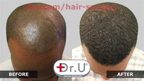 Hair of black men are sort of dry and brittle in nature, and hence, they must avoid harsh shampoos and hair care products that can prove detrimental or impede hair growth. Dr.UPunch Curl, Best Tool For FUE Hair Transplant for ...