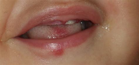 Your previous history had the abscesses confined to the oral cavity with local swelling on your gums. Abscess on gum - BabyCenter
