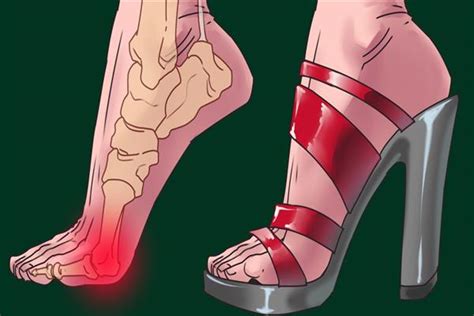 High Heels Will Damage Your Feet Knees And Back