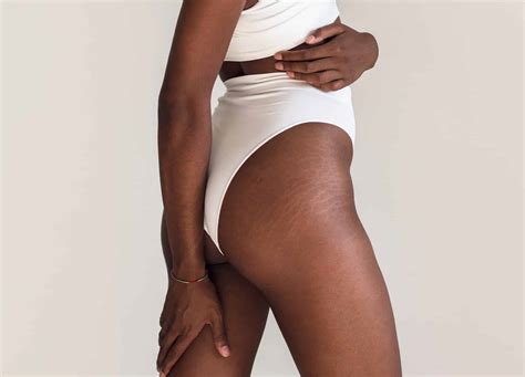 Dermatologist Recommended Treatments For Stretch Mark Removal