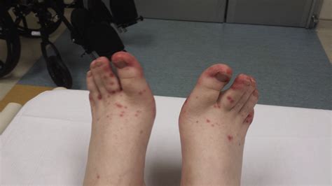 PEDs Rash On Bottom Of Feet