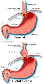 A hiatal hernia is a condition in which a small part of the stomach protrudes through an opening in the diaphragm into the chest cavity. Hiatal Hernia. Causes, symptoms, treatment Hiatal Hernia