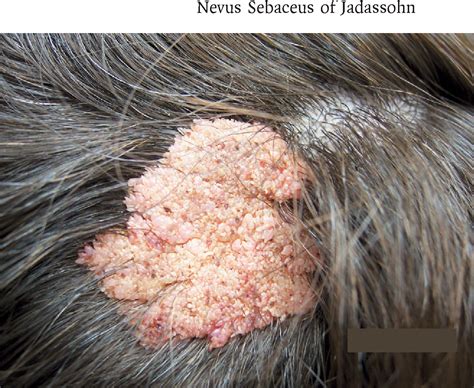 Images In Clinical Medicine Nevus Sebaceus Of Jadassohn Semantic